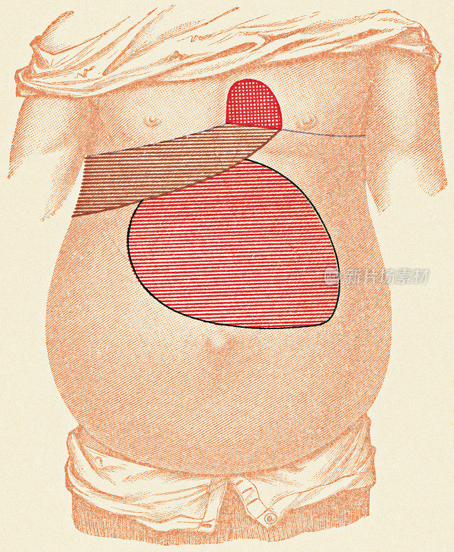 人体躯干的医学插图与一个病人的胰腺囊肿的叩诊检查点，正面视图- 19世纪